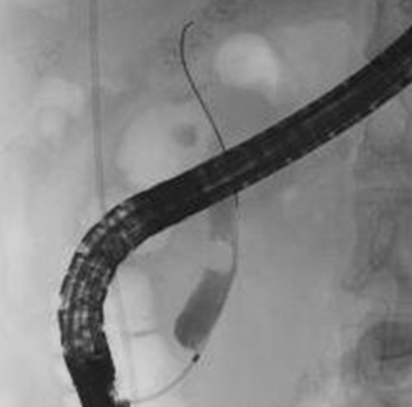 ERCP検査で確認された胆管内の結石の画像