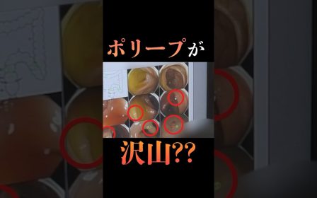 大腸にポリープが多く見つかり驚いた患者様のリアルな声を紹介
