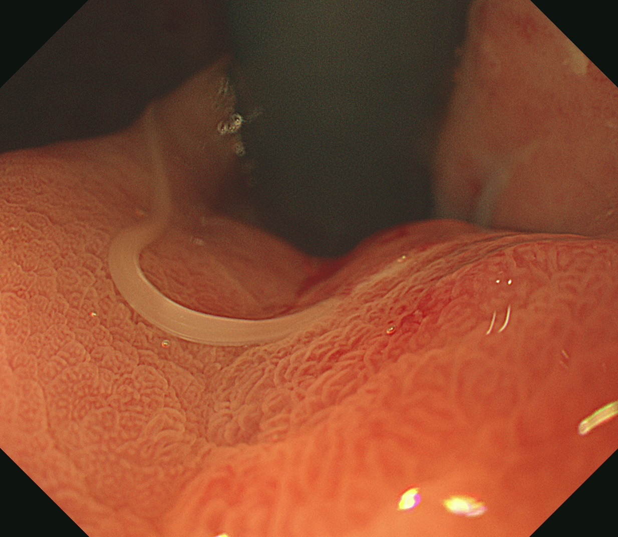胃の粘膜に寄生しているアニサキスの内視鏡画像