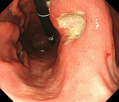 胃潰瘍の内視鏡写真