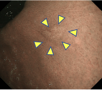 微小胃がん・NBI観察