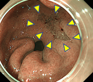 早期胃がん・NBI観察