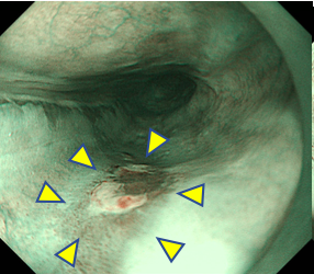 早期食道がん・NBI観察