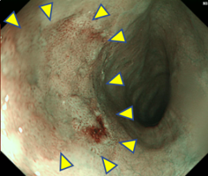 早期食道がんNBI観察