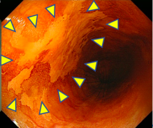 早期食道がんルゴール散布