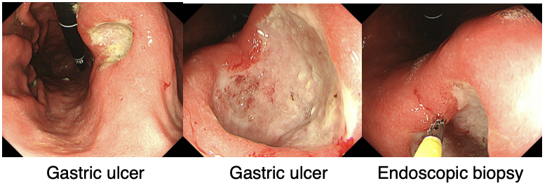 Gastric ulcer