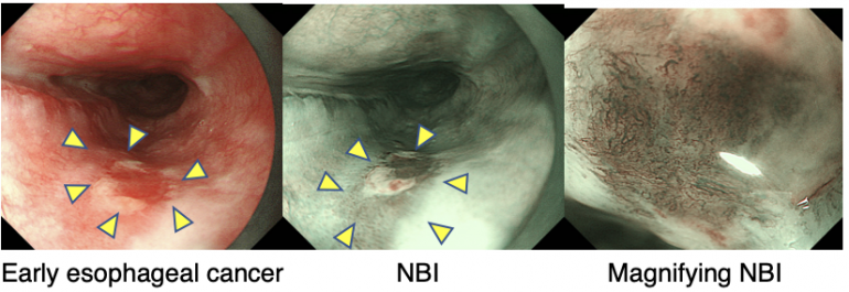 Gastric ulcer