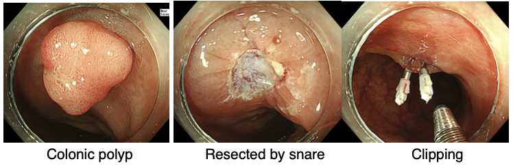 Colonic polyp