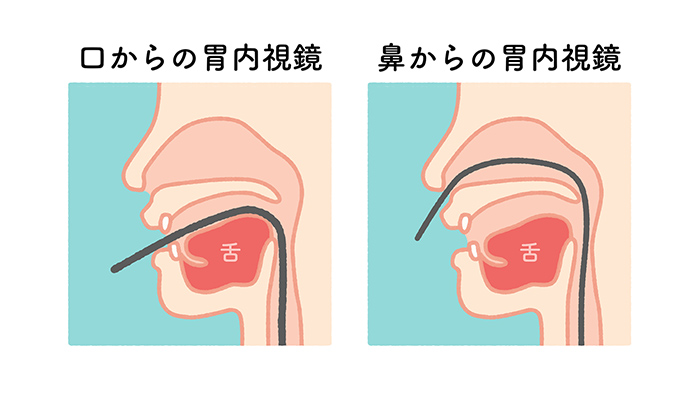 口からの胃内視鏡と鼻からの胃内視鏡の比較図(SP)