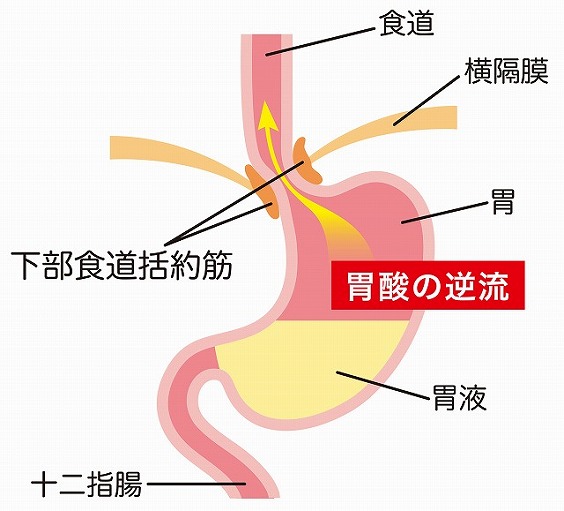 逆流性食道炎とは