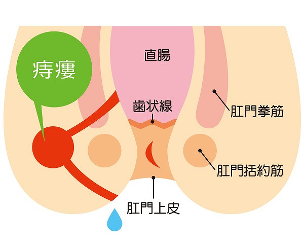 痔ろう（穴痔）と肛門周囲膿瘍