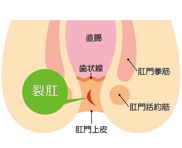 切れ痔（裂肛）とは