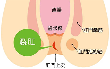 切れ痔（裂肛）