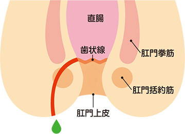痔ろう(あな痔)