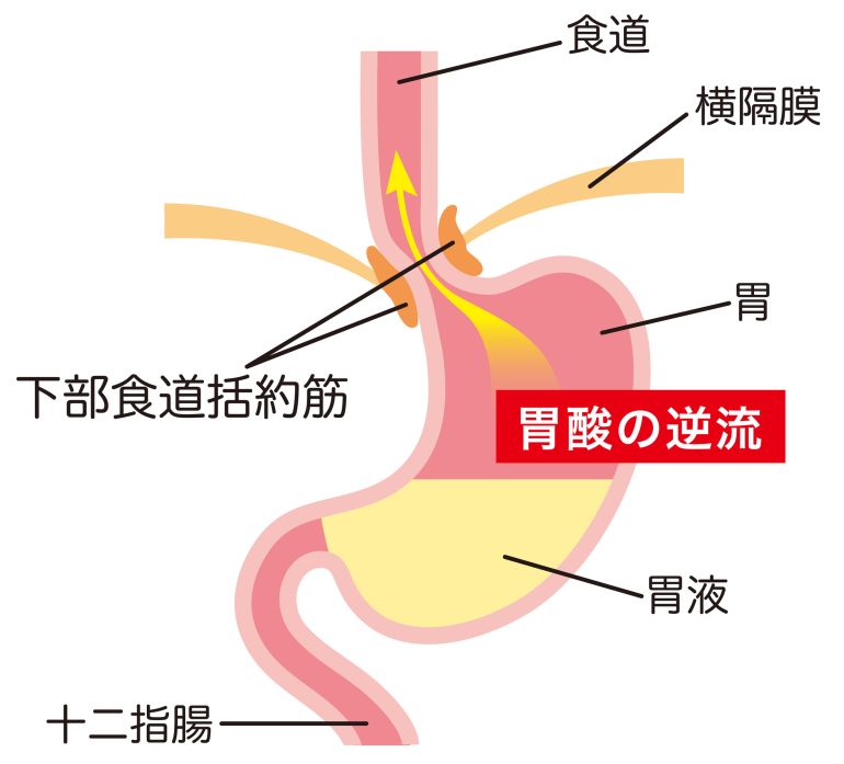 胃酸の逆流